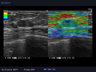 Real-time Tissue Elastography