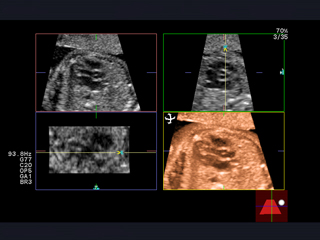 胎児心臓の観察に有効なSTIC機能